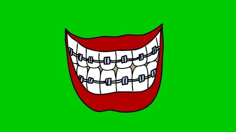 BRACES ON TEETH Video stock 122668114