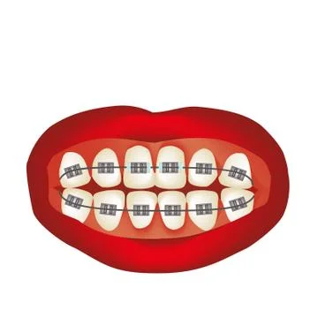 Braces on the teeth. Infographics. Vector illustration on isolated background. Stockillustratie