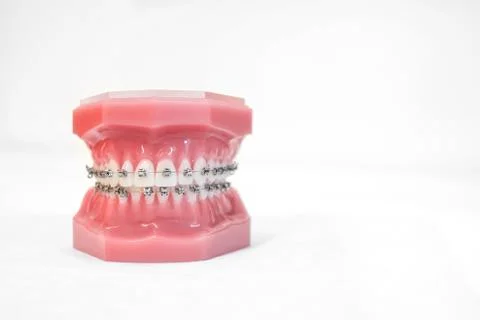 Braces on teeth model  of orthodontic bracket or brace Foto stock