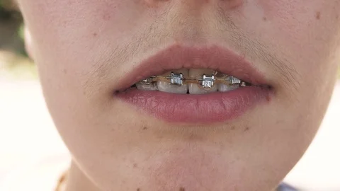 Braces on the teeth of a teenager, close up Stock Footage 111574466