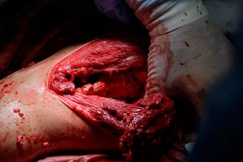 Brachial bone surgery Фото