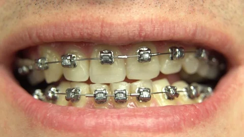 BRACKET SYSTEM Malocclusion of teeth Stock Footage 98656529