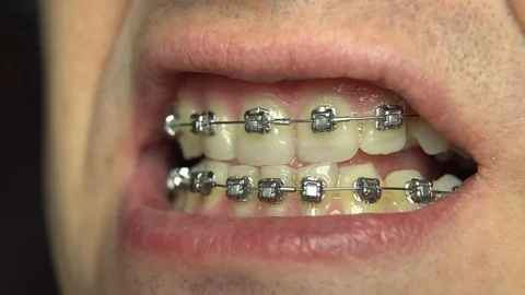 BRACKET SYSTEM Malocclusion of teeth Stock Footage 98657330