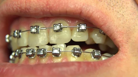 BRACKET SYSTEM Malocclusion of teeth Video stock 98657372