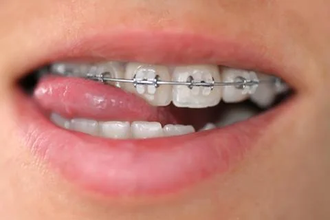 Bracket system in smiling mouth, macro photo teeth, close-up lips Stock Photos