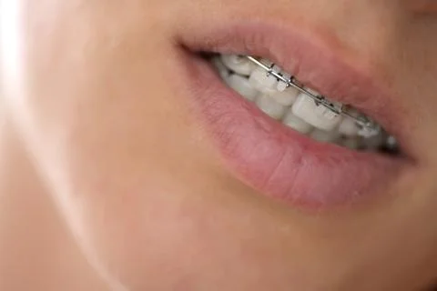 Bracket system in smiling mouth, macro photo teeth, close-up lips Stock Photos