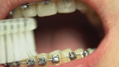 BRACKET SYSTEM TEETH CLEANING Video stock 98613397
