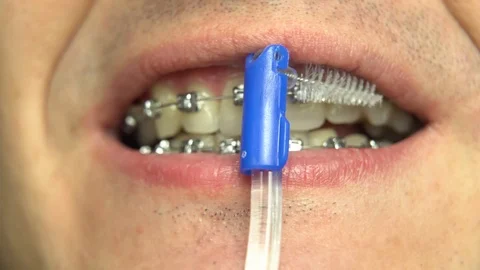 BRACKET SYSTEM TEETH CLEANING Stock Footage 98652448