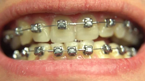 BRACKET SYSTEM TEETH CLEANING Video stock 98656104