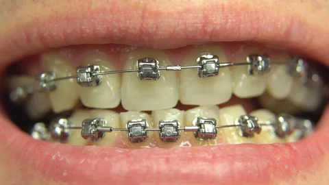 BRACKET SYSTEM TEETH CLEANING Stock Footage 98656307