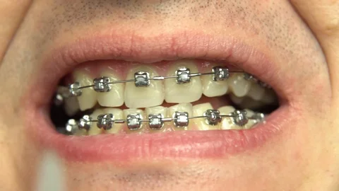 BRACKET SYSTEM TEETH CLEANING Stock Footage 98656437