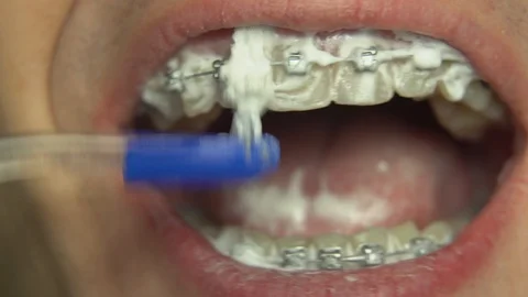 BRACKET SYSTEM TEETH CLEANING Stock Footage 98658470