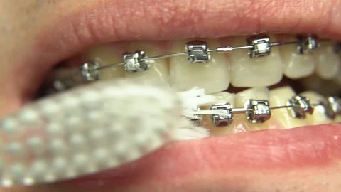 BRACKET SYSTEM TEETH CLEANING Stock Footage 98658582