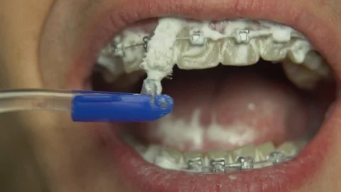 BRACKET SYSTEM TEETH CLEANING Stock Footage 98799087