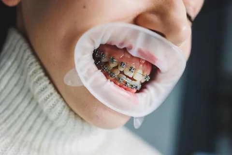 Bracket system on women's teeth. Installation of braces to align teeth. Ora.. Stock-Fotos