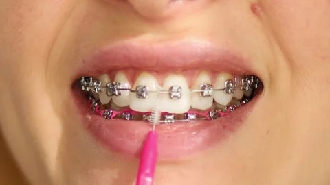 Brackets braces cleaning teeth with orthodontic toothbrushes. Vídeo Stock 331442622