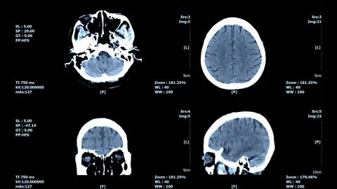 Brain-4 Stock Footage 98329768