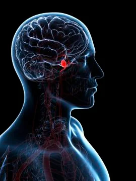 Brain aneurysm, artwork Stock Illustration