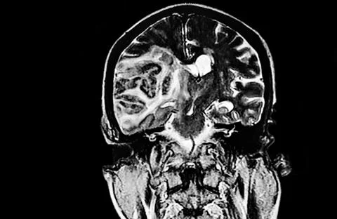 Brain CAT SCAN Stock Photos