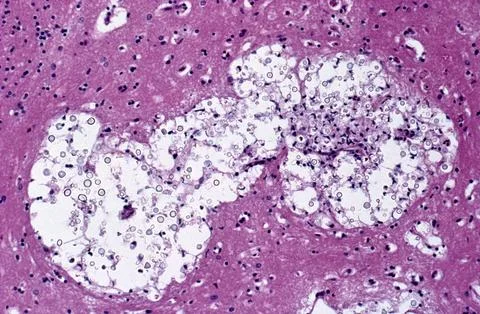Brain: cerebral cryptococcosis with AIDS Stock Illustration