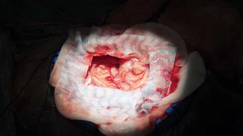 Brain close-up. Neurosurgery, brain surgery Stock Footage 152944561