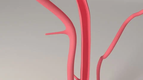 Brain Clot Removal Procedure Vídeo Stock 232670734