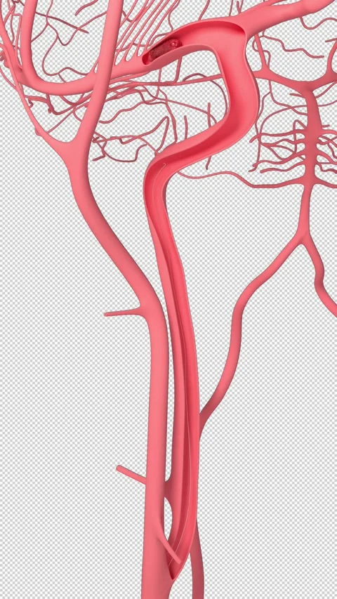 Brain Clot Removal  Vertical Video 스톡 동영상 235850238