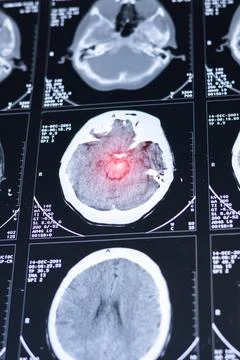 Brain computed tomography (CT) scan of a patient. Learning head diseases. V.. Foto stock