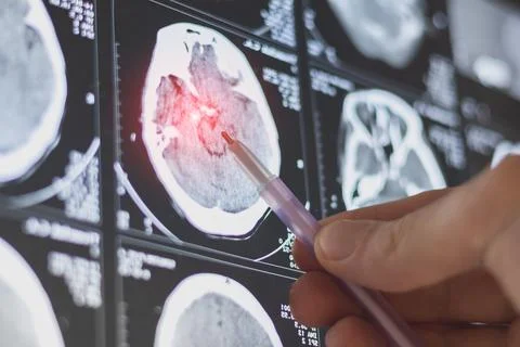 Brain computed tomography (CT) scan of a patient. Learning head diseases. Stock Photos