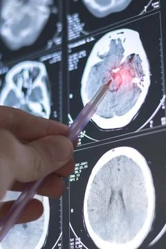 Brain computed tomography (CT) scan of a patient. Learning head diseases. V.. 스톡 사진