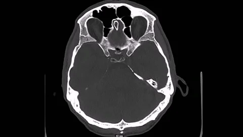 Brain Computed Tomography 库存影片 196876701