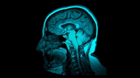 Brain computer tomography result visualization Stock Footage 125429738