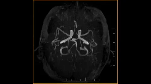 Brain CT Scan, Bone Thin Sequence 4 Stock Footage 259131917