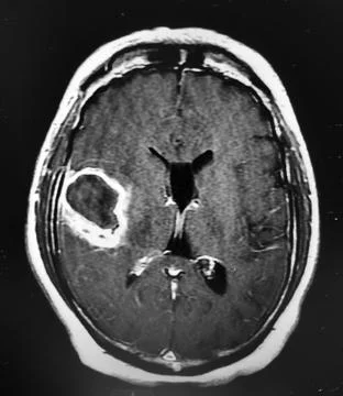 Brain CT showing E. coli Brain Abscess Foto stock