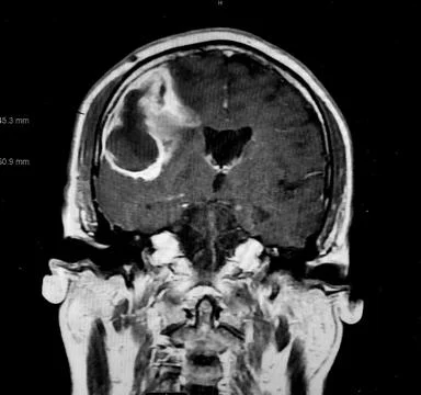 Brain CT showing E. coli Brain Abscess Stock Photos
