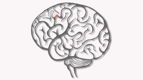 Brain destruction, animation. Focus of brain disease. Stock Footage 120795518