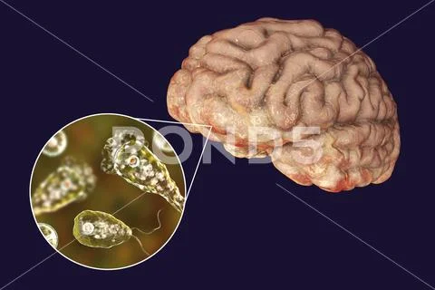 Brain-eating amoeba infection, naegleriasis Stock Illustration