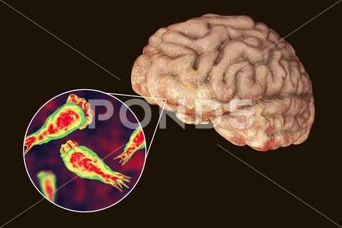 Brain-eating amoeba infection, naegleriasis Stock Illustration