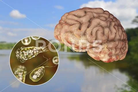 Brain-eating amoeba infection, naegleriasis Stock Illustration