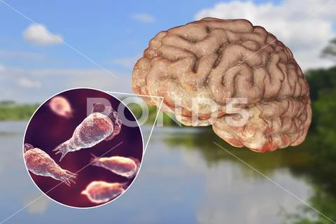 Brain-eating amoeba infection, naegleriasis Stock Illustration