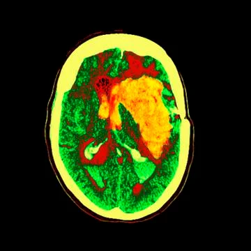 Brain haemorrhage, MRI scan Stock Illustration