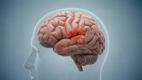 Brain Hemorrhage Visualization Concept. 스톡 동영상 343230089