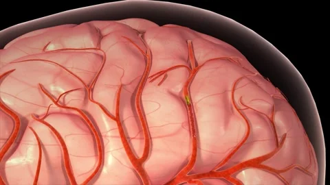Brain hemorrhage visualized in 3D medical animation. 스톡 동영상 344102845