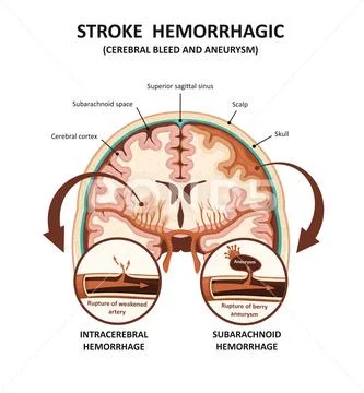 Brain hemorrhagic stroke. Cerebral bleed and aneurysm.: Royalty Free ...