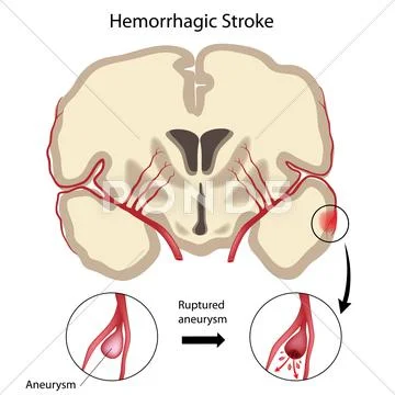 Brain hemorrhagic stroke Stock Illustration