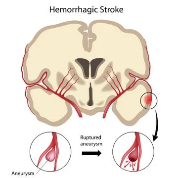 Brain hemorrhagic stroke Stock Illustration