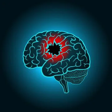 A brain with a hole, the concept of destruction of the brain, memory, stroke Illustrazione stock