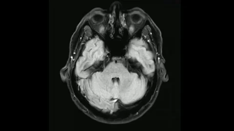 Brain imaging mri scan concept health future technology human research illness Stock Footage 336569201