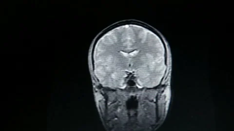 Brain imaging mri scan concept health future technology human research illness Stock Footage 336569243