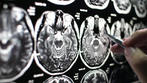Brain imaging mri scan concept health future technology human research illness 스톡 동영상 336569324